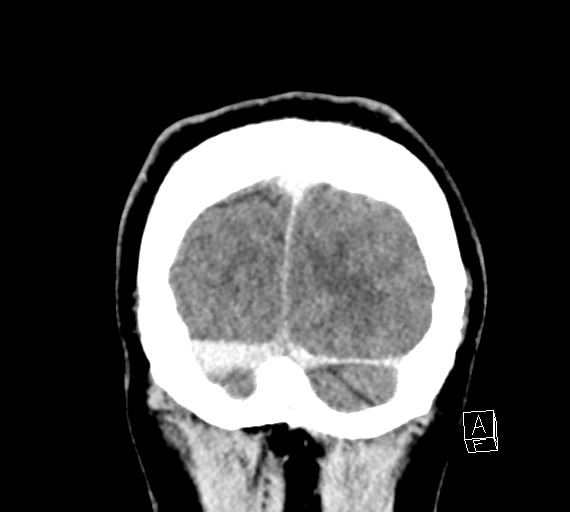 Cerebral metastases - testicular choriocarcinoma (Radiopaedia 84486-99855 D 57).jpg