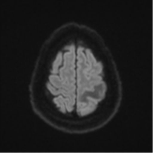 Cerebral metastases mimicking multifocal glioblastoma (Radiopaedia 50843-56353 Axial DWI 51).png