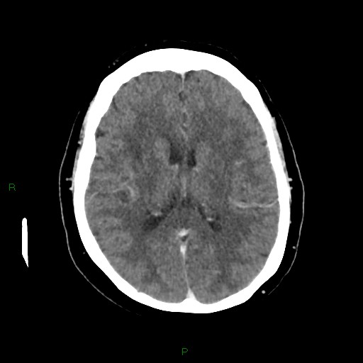 File:Cerebral metastasis from renal cell carcinoma (Radiopaedia 82306-96375 Axial C+ delayed 22).jpg