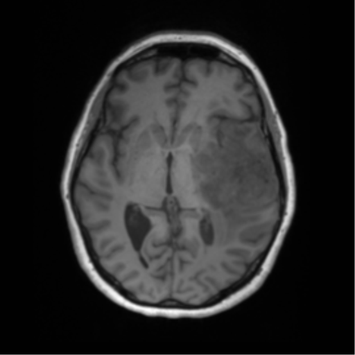 Cerebral metastasis mimicking glioblastoma (Radiopaedia 69155-78937 Axial T1 30).png