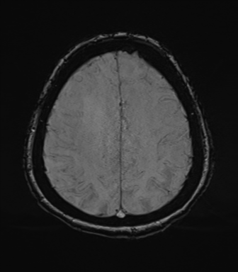 Cerebral metastasis to basal ganglia (Radiopaedia 81568-95413 Axial SWI 67).png