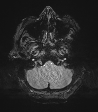 File:Cerebral metastasis to basal ganglia (Radiopaedia 81568-95413 Axial SWI magnitude 10).png