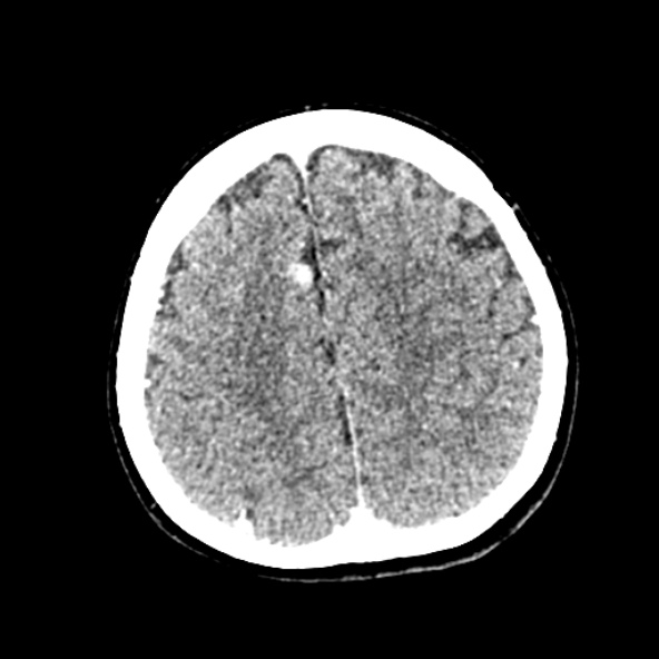 Cerebral ring enhancing lesions - cerebral metastases (Radiopaedia 44922-48818 B 211).jpg