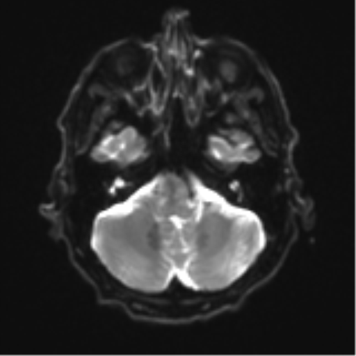 Cerebral toxoplasmosis (Radiopaedia 54575-60804 Axial DWI 9).png