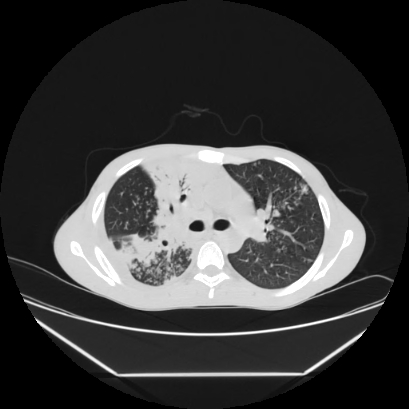 File:Cerebral tuberculoma (Radiopaedia 80829-94318 Axial lung window 65).jpg