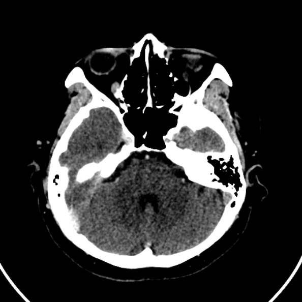 File:Cerebral venous hemorrhagic infarct from venous sinus thrombosis (Radiopaedia 55433-61883 Axial C+ delayed 110).jpg
