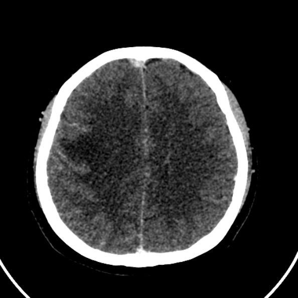 Cerebral venous hemorrhagic infarct from venous sinus thrombosis (Radiopaedia 55433-61883 Axial C+ delayed 55).jpg