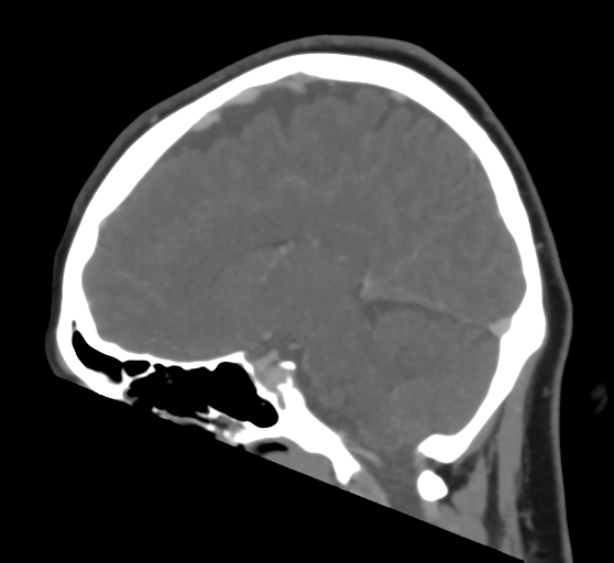 Cerebral venous infarction due to transverse sinus thrombosis (Radiopaedia 34688-36120 Sagittal CT venogram 31).png