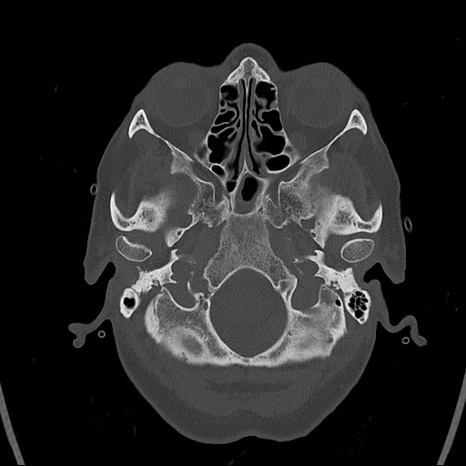 Cerebral venous infarction with hemorrhage (Radiopaedia 65343-74381 Axial bone window 10).jpg