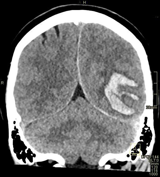 File:Cerebral venous sinus thrombosis (Radiopaedia 91329-108965 Coronal non-contrast 41).jpg