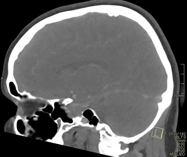 File:Cerebral venous sinus thrombosis (Radiopaedia 91329-108965 Sagittal venogram 32).jpg