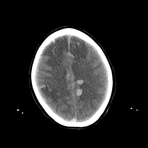 Cerebral venous throbmosis - hemorrhagic venous infarction (Radiopaedia 87318-103613 Axial non-contrast 118).jpg