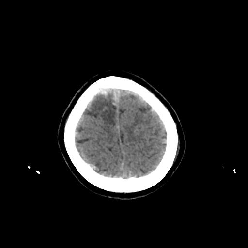 Cerebral venous throbmosis - hemorrhagic venous infarction (Radiopaedia 87318-103613 Axial non-contrast 155).jpg