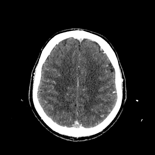 File:Cerebral venous thrombosis (CVT) (Radiopaedia 77524-89685 Axial with contrast 27).jpg