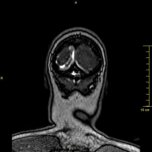 File:Cerebral venous thrombosis (Radiopaedia 23288-23351 MRV 172).JPG