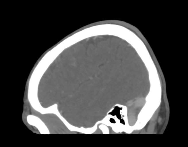 Cerebral venous thrombosis (Radiopaedia 38392-40467 D 10).png