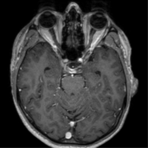 Cerebral venous thrombosis (Radiopaedia 38392-40469 Axial T1 C+ 30).png