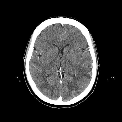 File:Cerebral venous thrombosis with venous hemorrhagic infarct (Radiopaedia 90354-107660 Axial with contrast 84).jpg