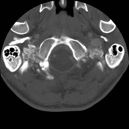Cervical Pott disease (Radiopaedia 20374-20286 Axial bone window 12).jpg