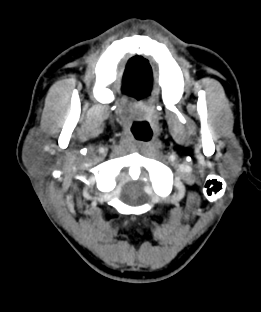 Cervical abscess (Radiopaedia 43725-47184 A 14).png
