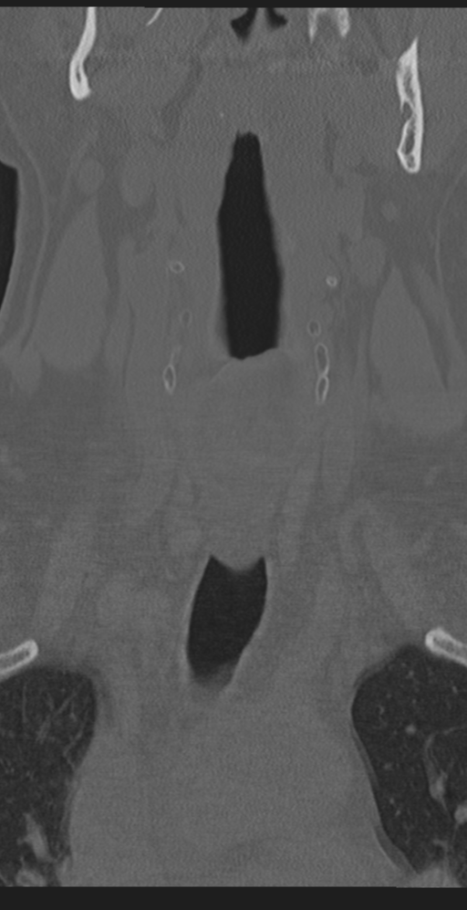 Cervical canal stenosis due to ossification of the posterior longitudinal ligament (Radiopaedia 47260-51823 Coronal bone window 6).png