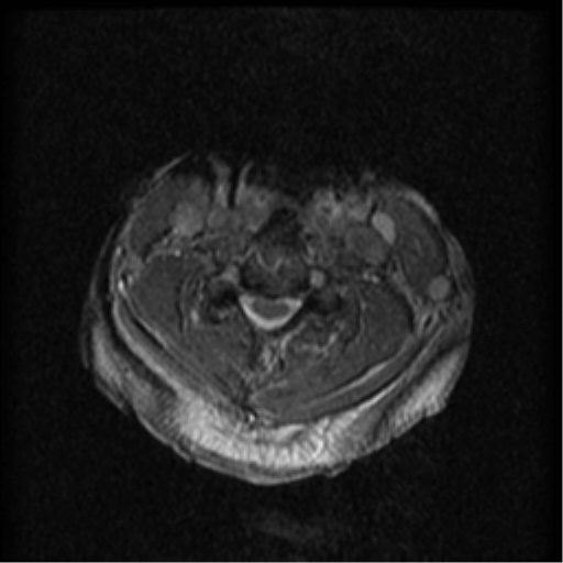 Cervical canal stenosis with cord compression (Radiopaedia 34114-35374 Axial Gradient Echo 46).png