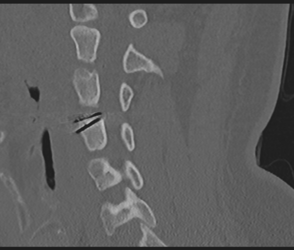 Cervical disc replacement (Radiopaedia 44025-47541 Sagittal bone window 50).png
