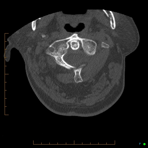 Cervical spine fracture - ankylosing spondylitis (Radiopaedia 76835-88706 Axial bone window 35).jpg