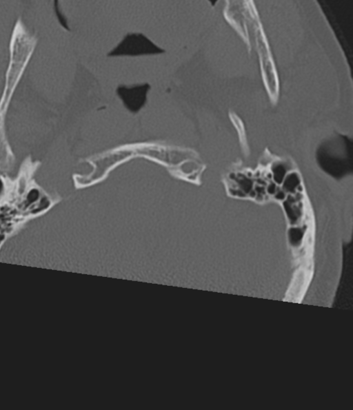 Cervical spine fracture in the setting of ankylosis (Radiopaedia 37038-38715 Axial bone window 6).png
