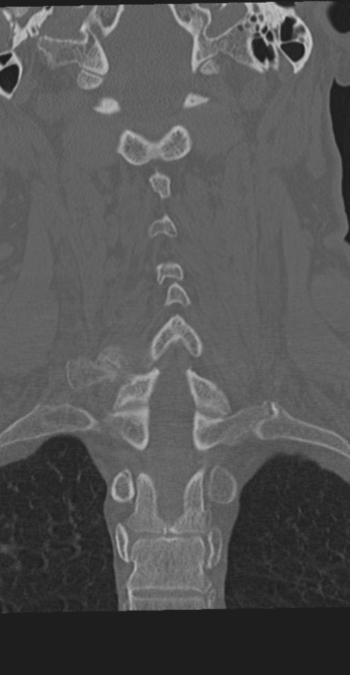 Cervical spine fracture in the setting of ankylosis (Radiopaedia 37038-38715 Coronal bone window 45).png