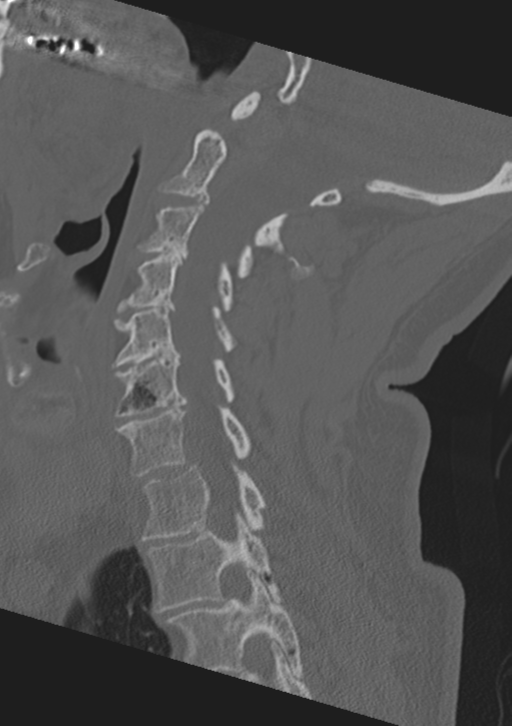 Cervical spine fractures with vertebral artery dissection (Radiopaedia 53296-59268 Sagittal bone window 40).png