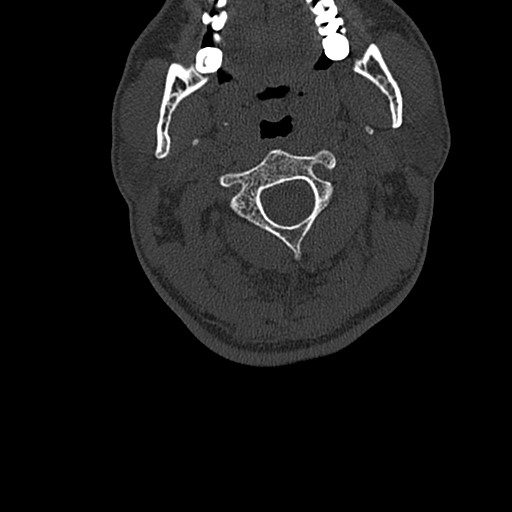 Cervical spine trauma with tear drop fracture and perched facet joint (Radiopaedia 53989-60127 Axial bone window 38).jpg