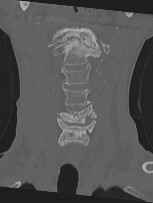 Cervical spondylolysis (Radiopaedia 49616-54811 Coronal bone window 12).png
