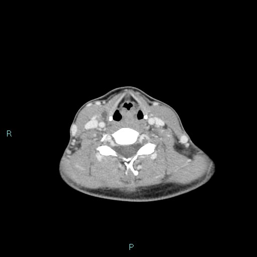 Cervical thymic cyst (Radiopaedia 88632-105335 C 52).jpg