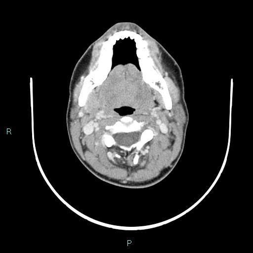 Cervical thymic cyst (Radiopaedia 88632-105335 C 81).jpg