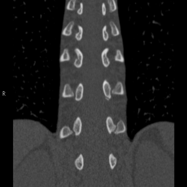 Chance fracture (Radiopaedia 36521-38081 Coronal bone window 39).jpg