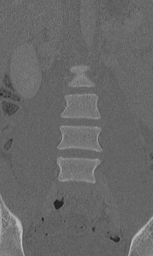 Chance fracture (Radiopaedia 40360-42912 Coronal bone window 19).png