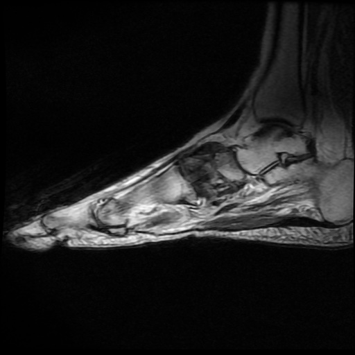 File:Charcot arthropathy (Radiopaedia 55056-61422 Sagittal T1 in-phase 7).jpg