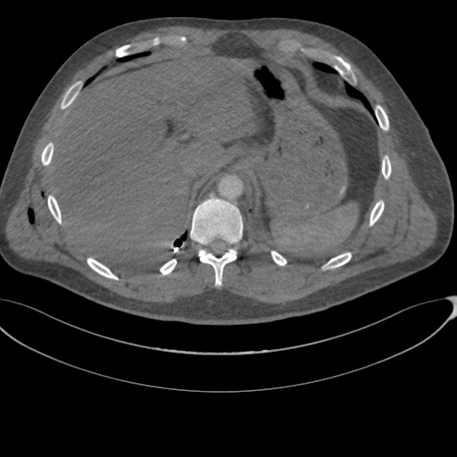 File:Chest multitrauma - aortic injury (Radiopaedia 34708-36147 A 267).png