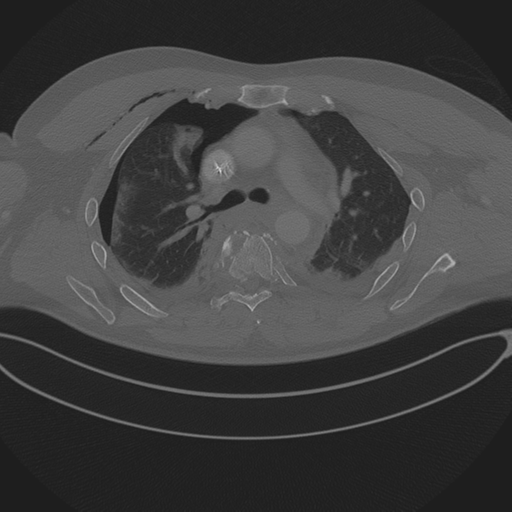 File:Chest multitrauma - aortic injury (Radiopaedia 34708-36147 Axial bone window 115).png