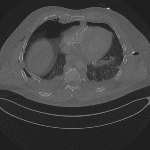 Chest multitrauma - aortic injury (Radiopaedia 34708-36147 Axial bone window 205).png
