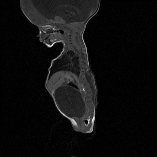 File:Chiari II malformation with spinal meningomyelocele (Radiopaedia 23550-23652 Sagittal T1 7).jpg