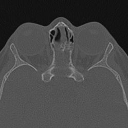 Choanal atresia (Radiopaedia 88525-105975 Axial bone window 95).jpg