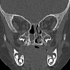 Choanal atresia (Radiopaedia 88525-105975 Coronal bone window 59).jpg