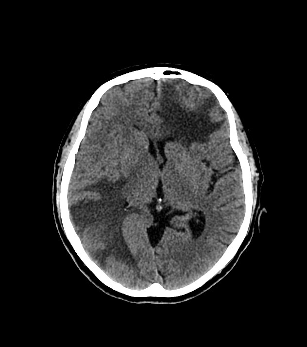 Cholangiocarcinoma with cerebral metastases (Radiopaedia 83519-98628 Axial non-contrast 35).jpg
