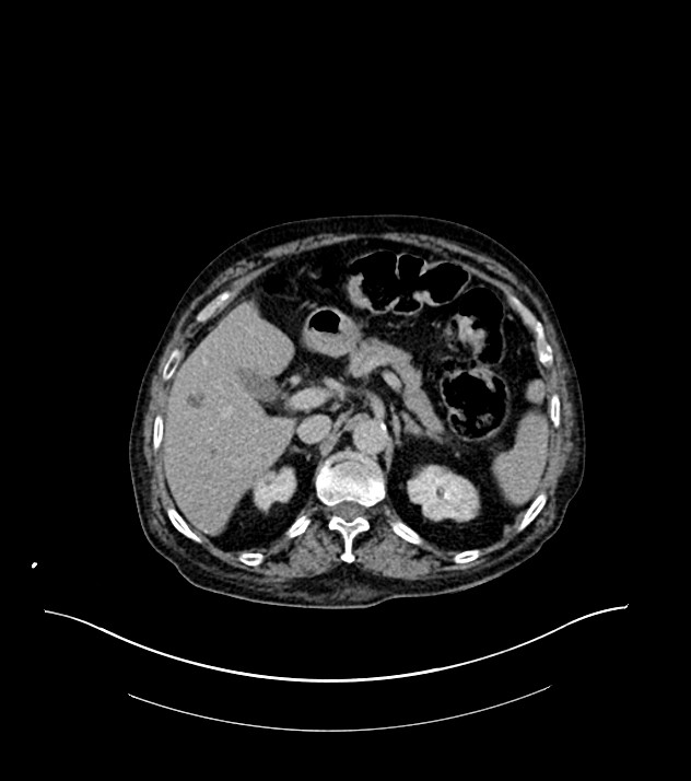 Cholangiocarcinoma with cerebral metastases (Radiopaedia 83519-98629 Axial C+ delayed 31).jpg