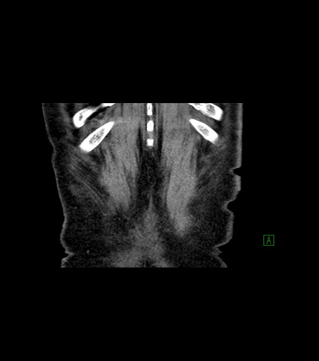 Cholangiocarcinoma with cerebral metastases (Radiopaedia 83519-98629 Coronal C+ delayed 79).jpg