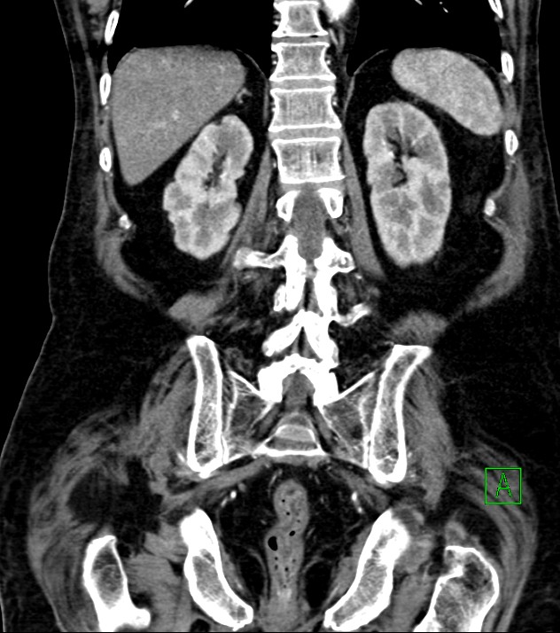 Cholangiocarcinoma with cerebral metastases (Radiopaedia 83519-98629 E 64).jpg