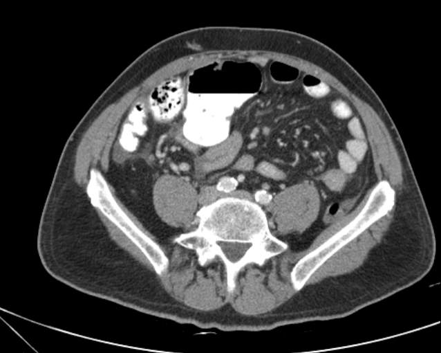 Cholecystitis - perforated gallbladder (Radiopaedia 57038-63916 A 56).jpg