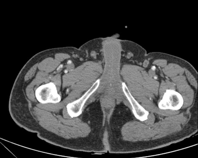 File:Cholecystitis - perforated gallbladder (Radiopaedia 57038-63916 A 87).jpg
